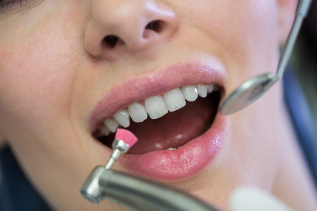 limpieza dental ultrasonica 